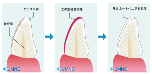 ラミネートベニア