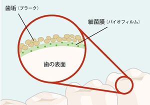 プラークコントロール