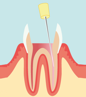 歯の神経の治療