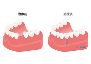 歯を1本失った場合