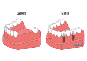 歯を何本か失った場合